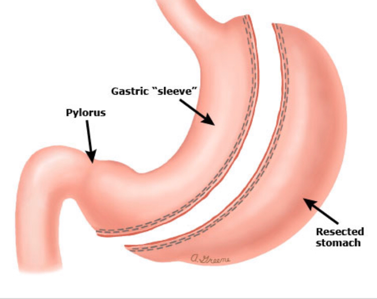 Arch Bariatrics: Kumaran Chinnappan, MD, FACS: Bariatric Weight Loss Surgery reviews