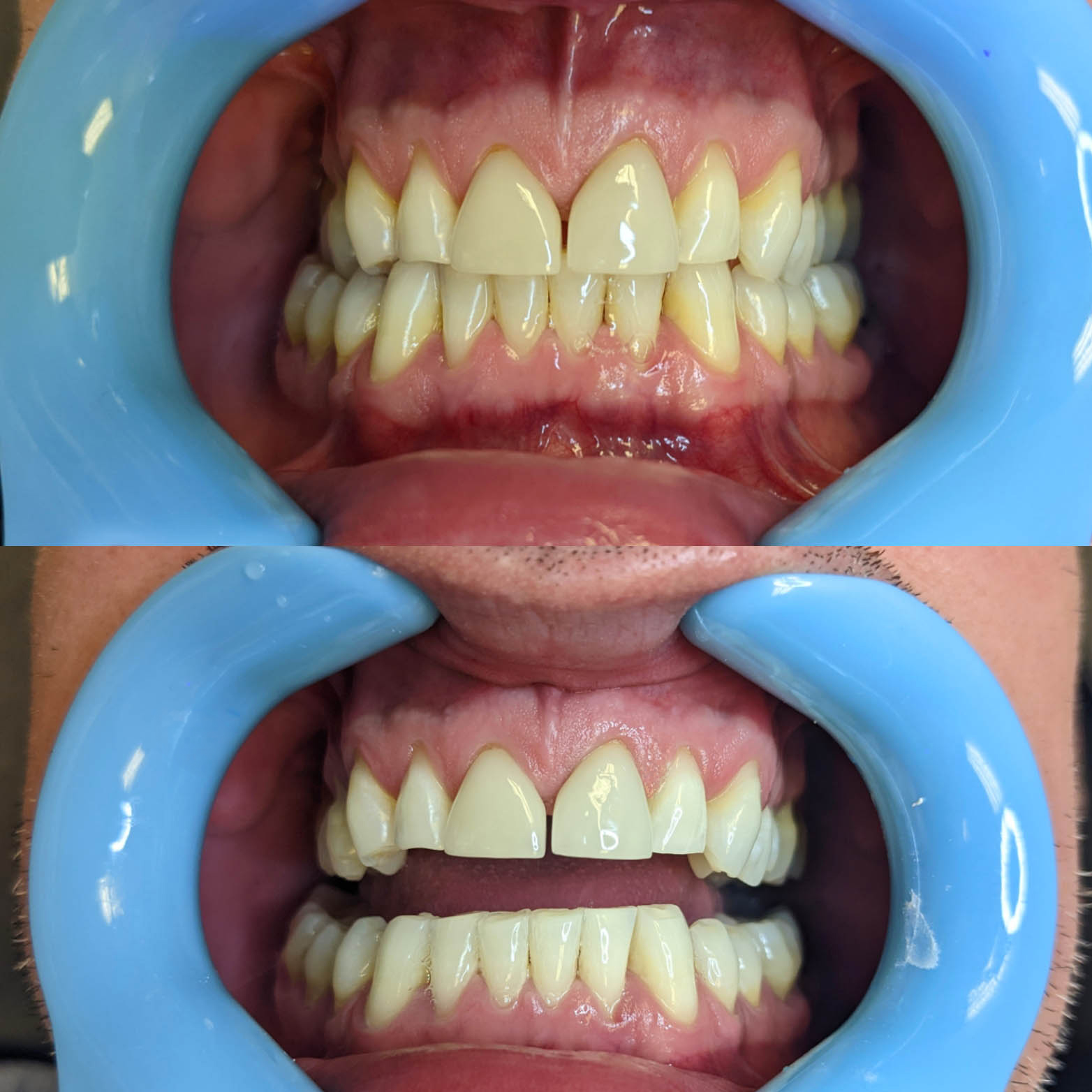 Ivory Teeth Whitening reviews